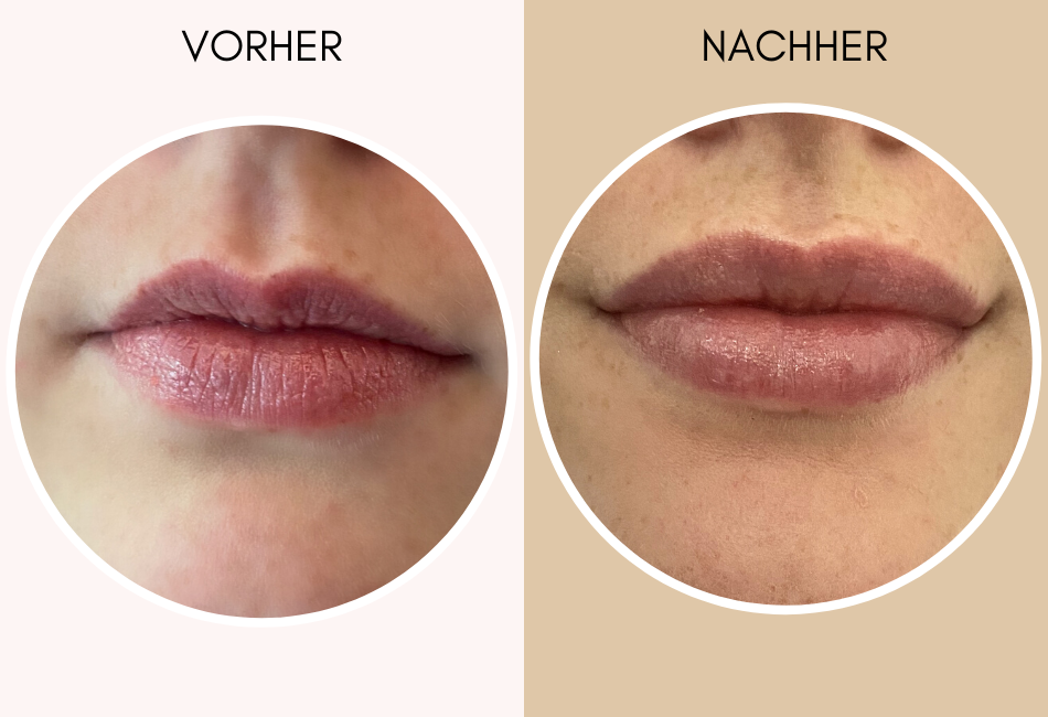 Lippen Aufspritzen Erfahrungen Zur Lippenunterspritzung Mit Hyaluronsaure Beauty Report