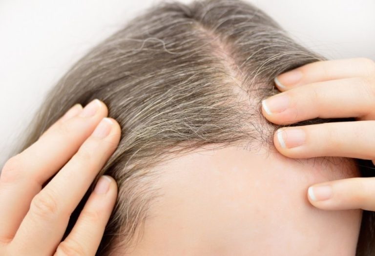 Stilvolle Fliegende Haare Krankheit Bild