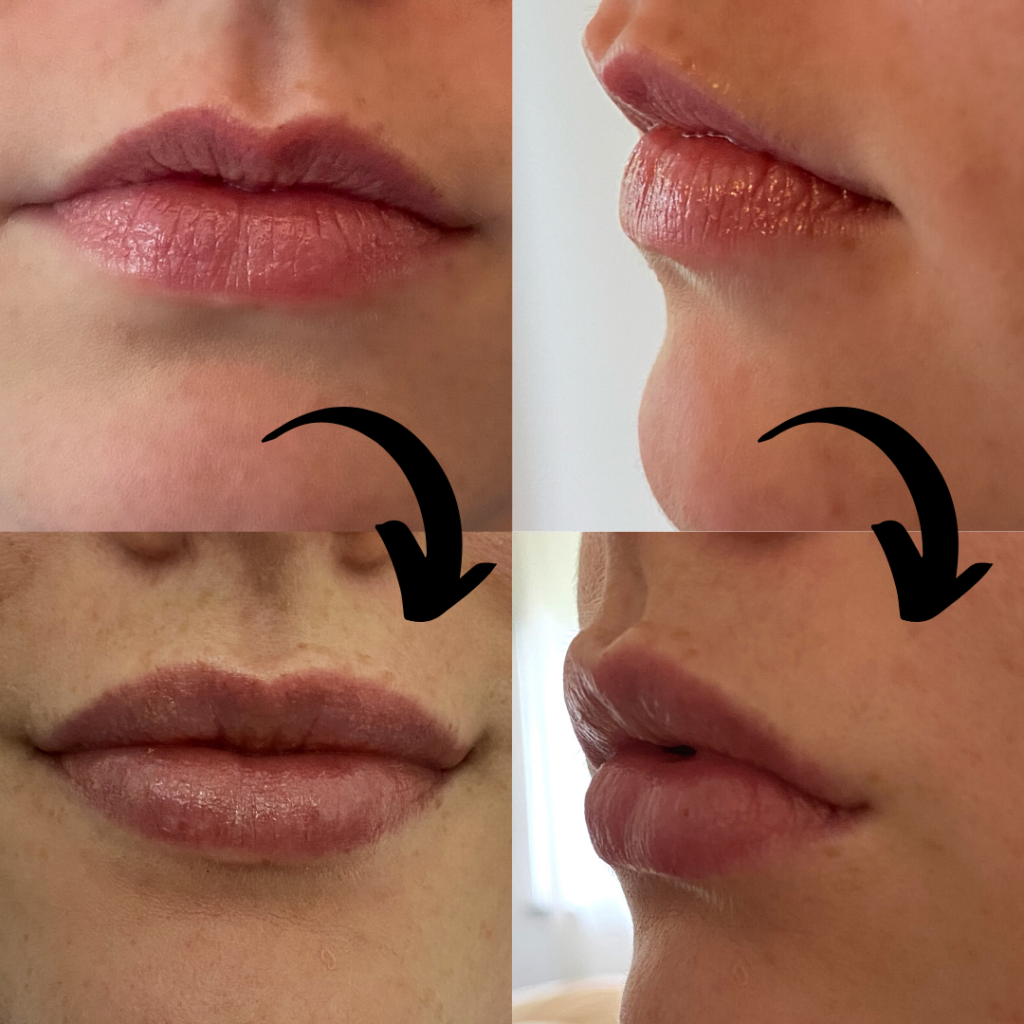 Lippen Aufspritzen Erfahrungen Zur Lippenunterspritzung Mit Hyaluronsaure Beauty Report