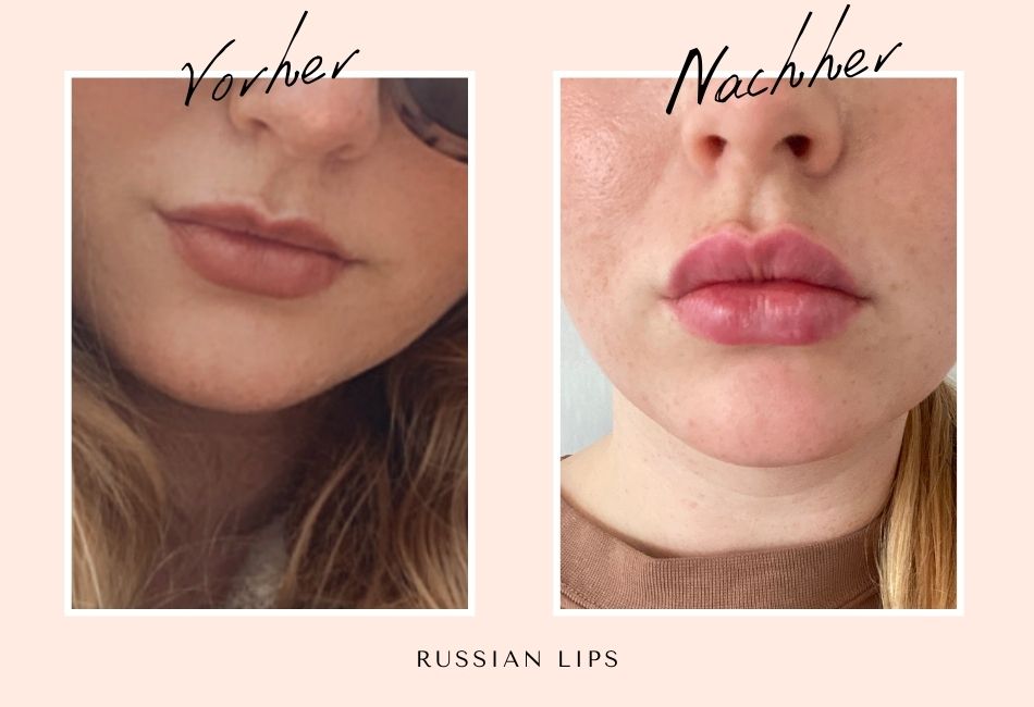 Vorher / Nachher Russian Lips