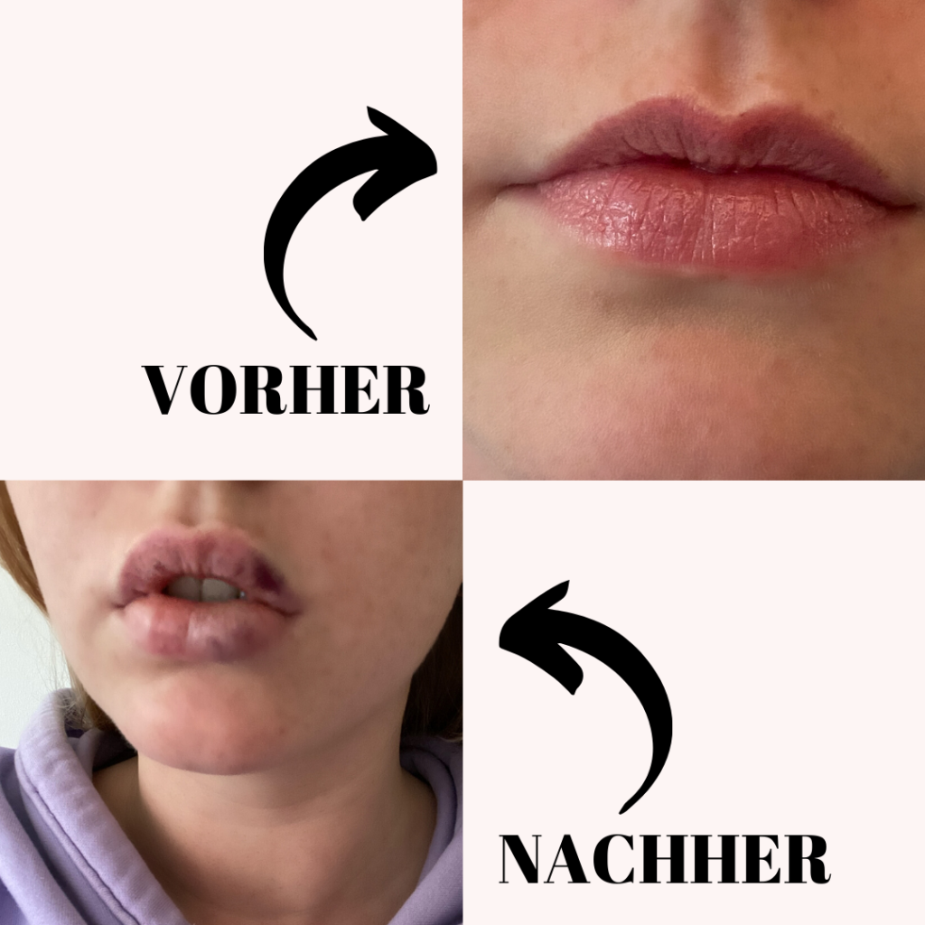 Schwellen an lippen Geschwollene Lippe